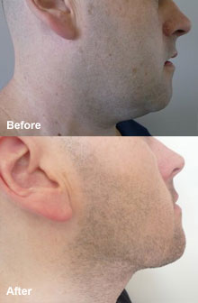 Laser liposuction on the neck.