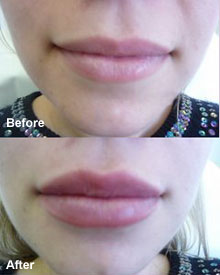 Get fuller, more contoured lips.